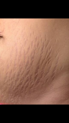 Candela Crema Corporal para Estrías y Textura