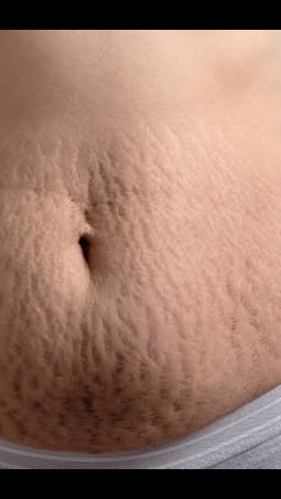 Candela Crema Corporal para Estrías y Textura