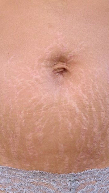 Candela Crema Corporal para Estrías y Textura