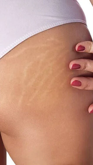 Candela Crema Corporal para Estrías y Textura