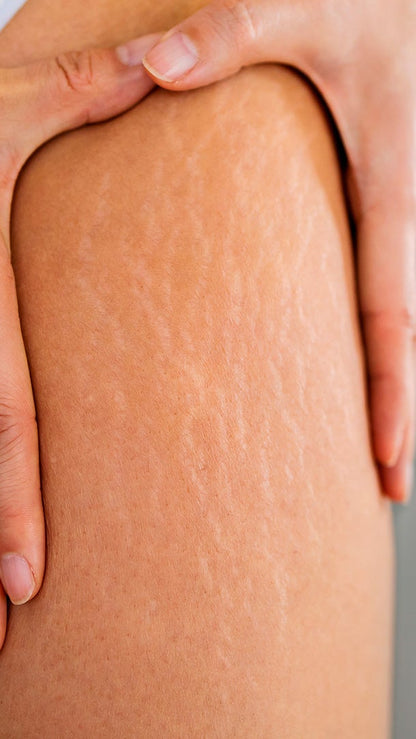 Candela Crema Corporal para Estrías y Textura