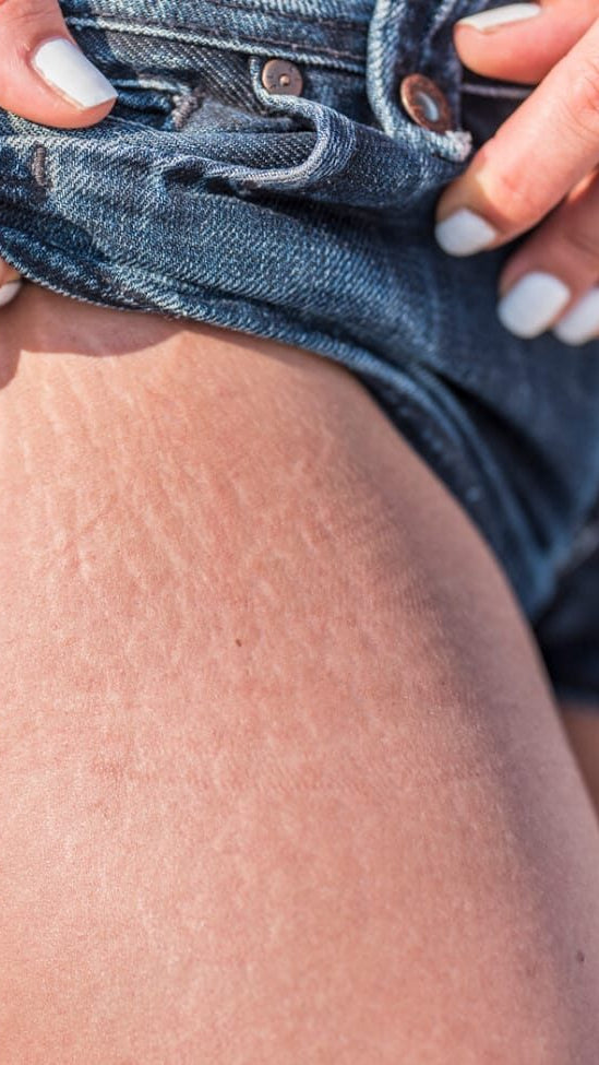 Candela Crema Corporal para Estrías y Textura