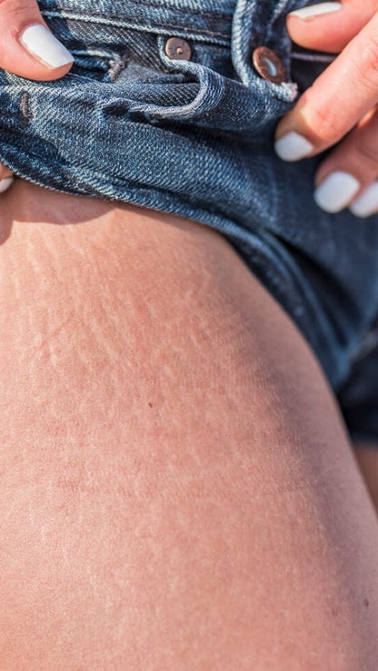 Candela Crema Corporal para Estrías y Textura